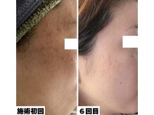 ハーブピーリングHYの雰囲気（繰り返す肌荒れを根本的に改善します◎）