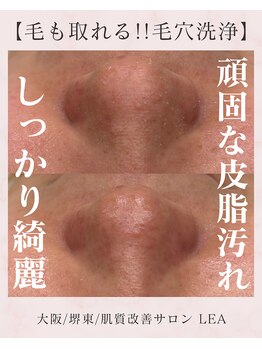レア(Lea)/頑固な皮脂.毛穴汚れを除去＊