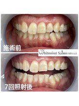 ホワイトニングサロン 京都烏丸店/ホワイトニング施術例