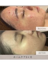 スウィート 刈谷店(Sweet)/【TROI PEEL】ハーブピーリング