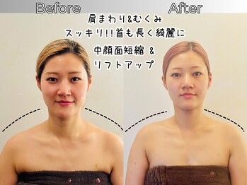 リストアハート(Restore Heart)/小顔だけじゃない！首肩こりにも