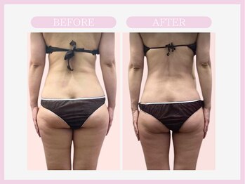 スリムライン 弘前店(The Slim Line)/before→after