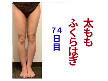 アミュレット 京都(amulette)/【太もも＋ふくらはぎ】74日目