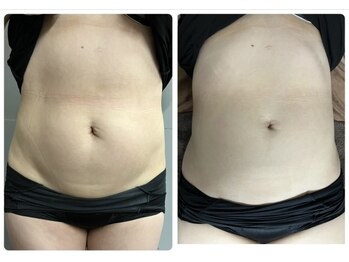 クー(9 Kuu)/痩身◇フォースカッター症例