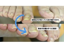 巻き爪じゅん 船橋店/巻き爪の原因は“食い込み”！