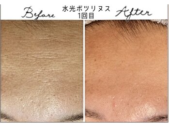 アリュール 倉敷(ALLURE)の写真/最新美肌ケア【今までにない体感と効果をエステでも】1回の導入効果が凄い◎毛穴の開き/赤み/しわ改善に◎