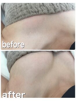 サロン ド チョコ(SALON DU CHOCO)/【バストアップ】症例