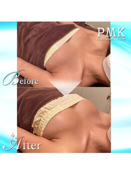 PMK 上野店/バスト１回施術