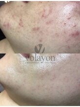 ポピン(POPIN)/VERDOSO＊volayonの再生ライン