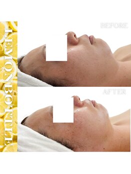 リアム(LiAm)/脂肪分解剤《レモンボトル》