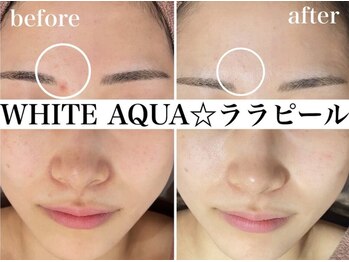 ホワイトアクア 浜松店(WHITE AQUA)/ララピール/ニキビケア