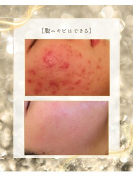 スノースキン(Snow skin)/ニキビケア/ハーブピーリング