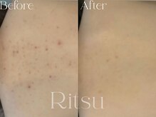 リツ(Ritsu)/背中ニキビケア