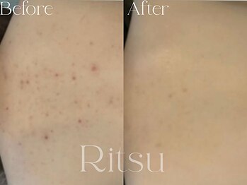 リツ(Ritsu)/背中ニキビケア