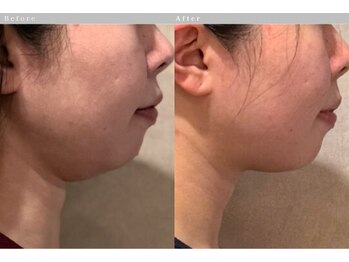 ルーツリー(Rootree)/小顔リフトアップ