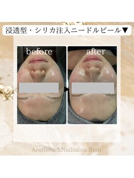 ビヌ(Binu)の写真/【希少！浸透型シリカ注入トリートメント】肌質改善・バリア機能をUP！敏感肌、大人ニキビのケアに◎