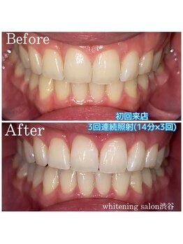 ダイヤモンドビューティー(DIAMOND BEAUTY)/ホワイトニング 渋谷