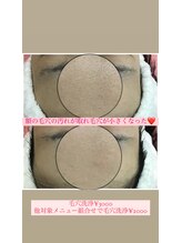 クラティス(CRATIS)/【毛穴洗浄】毛穴の黒ずみ改善