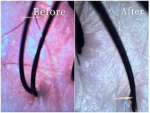 ベリルスパトリートメント(BERYL SPA TREATMENT)/健康な青白い頭皮に!/ヘッドスパ