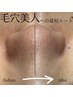 【凸凹肌・毛穴】速攻ハーブピーリング2B90分　￥19800