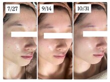 ホワイトアクア つくば店(WHITE AQUA)/ハーブピーリング/毛穴ケア/茨城