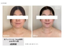 リーベ(Liebe)/大人気！光フェイシャル♪