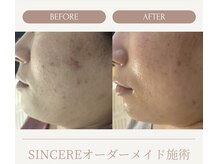 シンシア(SINCERE)/オーダーメイド肌改善プログラム