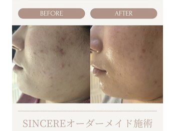 シンシア(SINCERE)/オーダーメイド肌改善プログラム