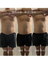 美容痩身ラボ 松山院/施術経過