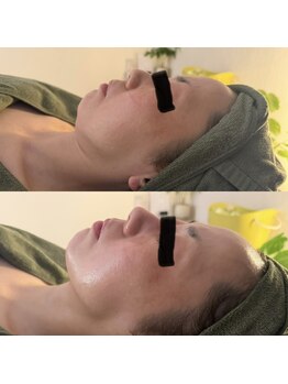 シーアイエステティック 船橋駅前店(c.iエステティック)/選べる美容液導入フェイシャル♪