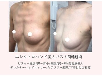 エイミー(Aimee)/バスト施術6回