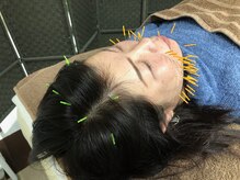 クローバー治療院/施術例：エラはり、頭痛