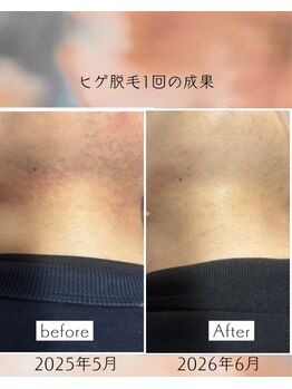 オフ(off)/ヒゲ脱毛