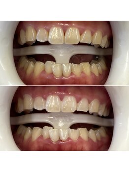 リトリート(Retreat)/ホワイトニング