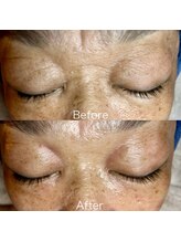 エミナル(EMINALu)/wishpro毛穴