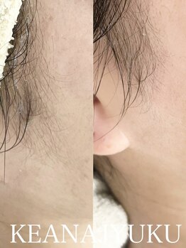 毛穴塾の写真/【大人気!顔脱毛】スキンケア発想から生まれた無添加フェイシャルWAX脱毛♪お顔のムダ毛を除去しうる艶肌に