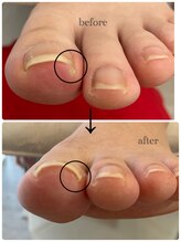 アウラ/巻き爪矯正6ヶ月で卒業のお客様