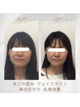 りもあず(ReMore-S)/食いしばり/えら張り/丸顔解消