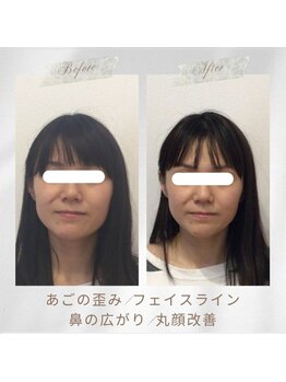 りもあず(ReMore-S)/食いしばり/えら張り/丸顔解消