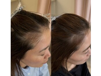 カナエル ビューティーサロン(Canael Beauty salon)/プロセルセラピーズ 4回