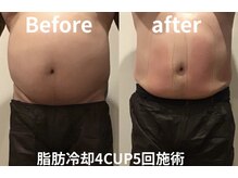 ユー 喜連西店(U)/脂肪冷却【before　after】
