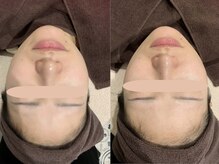 ピュアリー(purly)/【レモンボトル】Before After