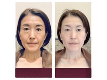 アクア エステティコ 亀有(ACQUA estetico)の雰囲気（シリカマイクロニードルなどフェイシャル変化）