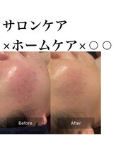 サロンツキ(salon tuki)/ハーブピーリング症例