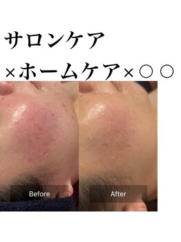 サロンツキ(salon tuki)/ハーブピーリング症例