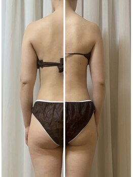 フォルスボーテ(Force Beaute)/脂肪分解20ml 20回導入結果