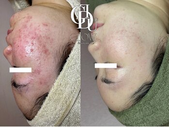 グロウ(GLOW)/ハーブピーリング/ニキビケア