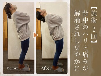 アロナプラス(Arona+)/施術2回