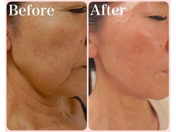 トータルビューティサロン クイーン(Queen)の写真/【結果重視の医療提携店】若かりしあの頃の肌へ。ほうれい線・目元たるみを根本改善し内側から弾力UP