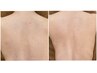全身スタート前に【美肌脱毛/セレクト1箇所】お試し￥5500